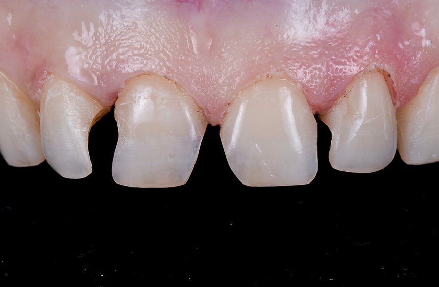 What Happens If You Get A Cavity With Veneers?
