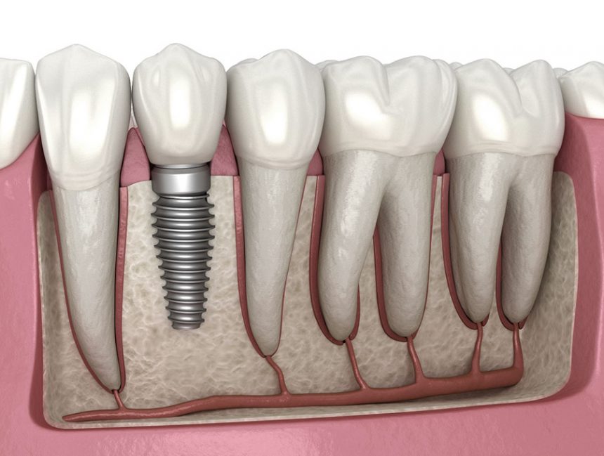 Things to Know When Getting Dental Implant in Turkey