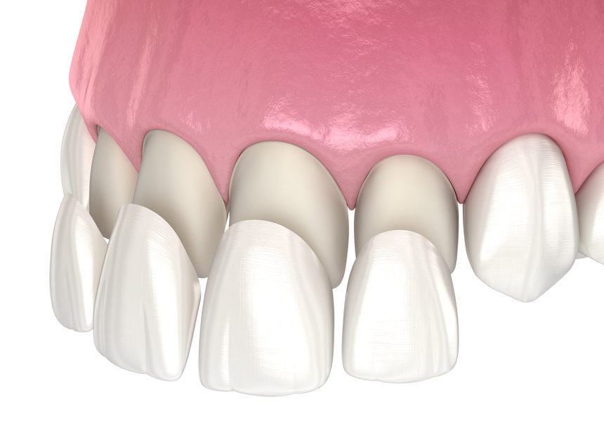 How Much is a Full Set of Veneers Cost in Turkey?