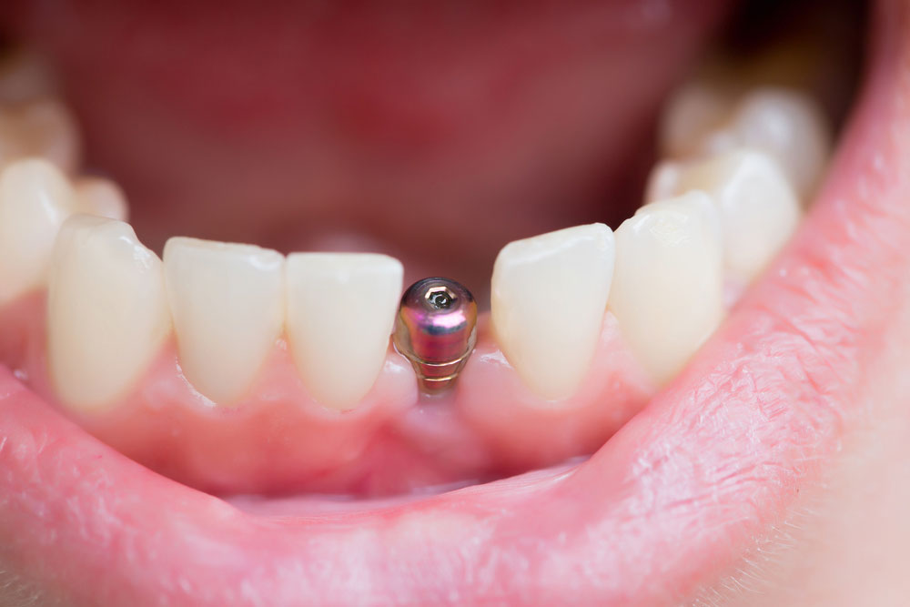 Do Dental Implants Hurt? 