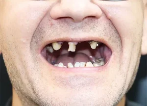 Full Mouth Dental Implants Turkey